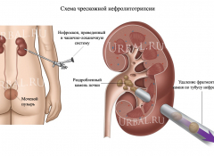 Контактное дробление камня почки